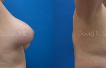 Breast Implant Revision Before and After | Sayah Institute