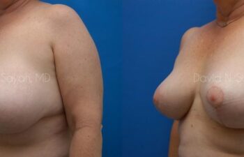 Breast Implant Revision Before and After | Sayah Institute
