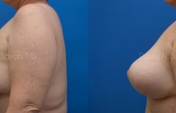 Breast Implant Revision Before and After | Sayah Institute