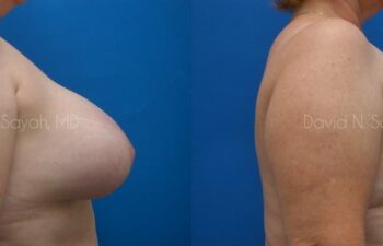 Breast Implant Revision Before and After | Sayah Institute