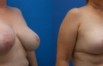 Breast Implant Revision Before and After | Sayah Institute