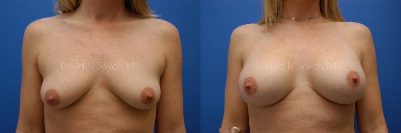 Breast Augmentation And Mastopexy Before and After | Sayah Institute