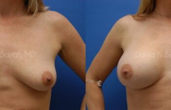 Breast Augmentation And Mastopexy Before and After | Sayah Institute