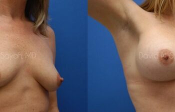 Breast Augmentation And Mastopexy Before and After | Sayah Institute