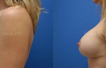 Breast Augmentation And Mastopexy Before and After | Sayah Institute