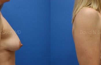Breast Augmentation And Mastopexy Before and After | Sayah Institute