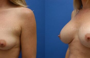 Breast Augmentation And Mastopexy Before and After | Sayah Institute