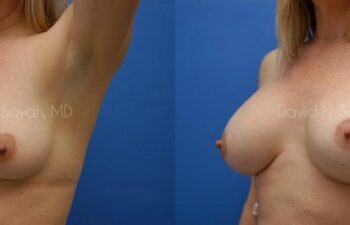Breast Augmentation And Mastopexy Before and After | Sayah Institute
