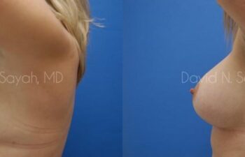 Breast Augmentation And Mastopexy Before and After | Sayah Institute