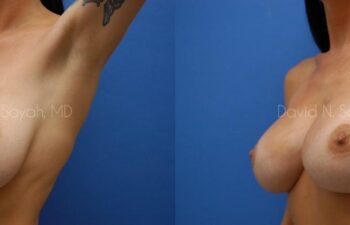 Breast Implant Revision Before and After | Sayah Institute