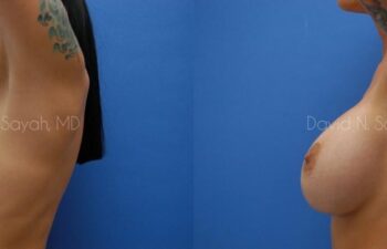 Breast Implant Revision Before and After | Sayah Institute