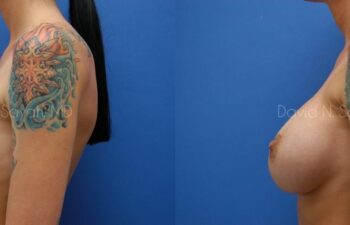 Breast Implant Revision Before and After | Sayah Institute
