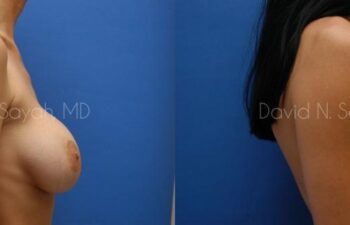Breast Implant Revision Before and After | Sayah Institute