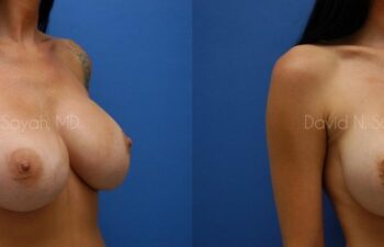 Breast Implant Revision Before and After | Sayah Institute