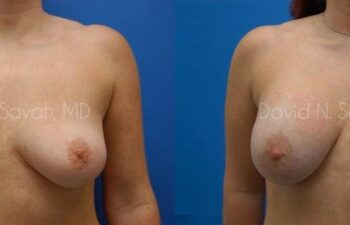 Breast Implant Revision Before and After | Sayah Institute