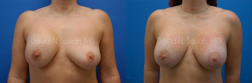 Breast Implant Revision Before and After | Sayah Institute