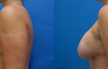 Breast Implant Revision Before and After | Sayah Institute