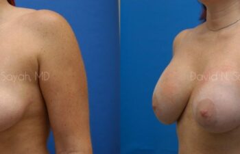 Breast Implant Revision Before and After | Sayah Institute