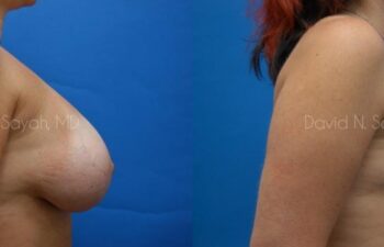 Breast Implant Revision Before and After | Sayah Institute