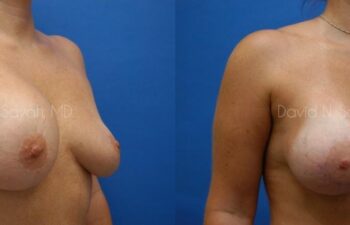 Breast Implant Revision Before and After | Sayah Institute