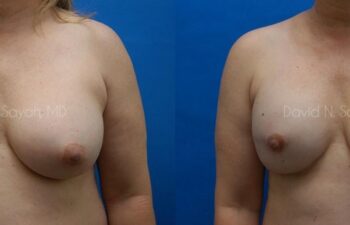 Breast Reconstruction Before and After | Sayah Institute