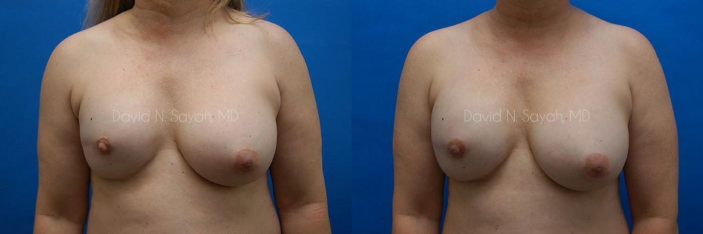 Breast Reconstruction Before and After | Sayah Institute