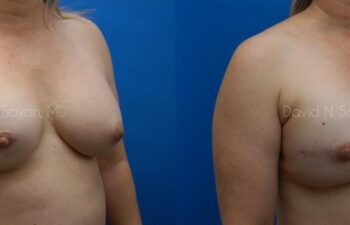 Breast Reconstruction Before and After | Sayah Institute