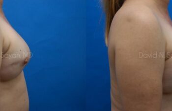 Breast Reconstruction Before and After | Sayah Institute