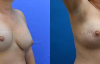 Breast Reconstruction Before and After | Sayah Institute
