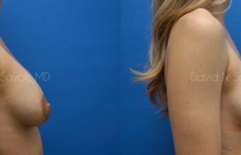 Breast Implant Revision Before and After | Sayah Institute