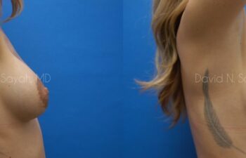 Breast Implant Revision Before and After | Sayah Institute