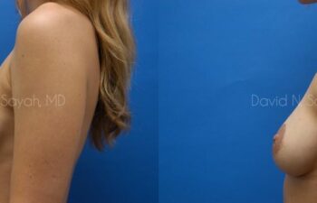 Breast Implant Revision Before and After | Sayah Institute