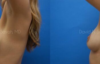 Breast Implant Revision Before and After | Sayah Institute