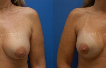 Breast Implant Exchange Before and After | Sayah Institute