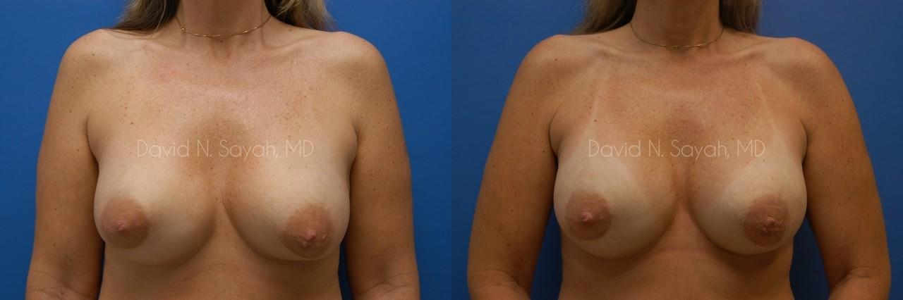 Breast Implant Exchange Before and After | Sayah Institute