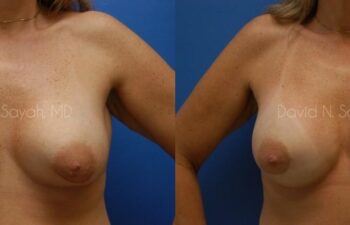Breast Implant Exchange Before and After | Sayah Institute