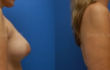 Breast Implant Exchange Before and After | Sayah Institute