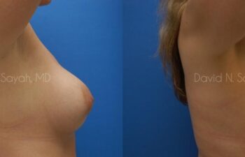 Breast Implant Exchange Before and After | Sayah Institute