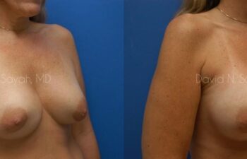 Breast Implant Exchange Before and After | Sayah Institute