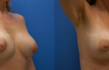 Breast Implant Exchange Before and After | Sayah Institute