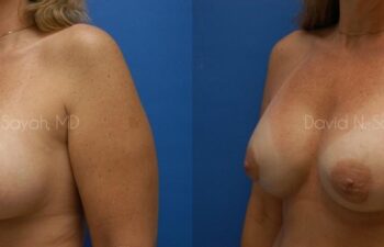 Breast Implant Exchange Before and After | Sayah Institute
