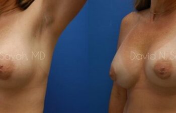 Breast Implant Exchange Before and After | Sayah Institute