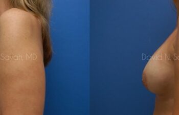 Breast Implant Exchange Before and After | Sayah Institute