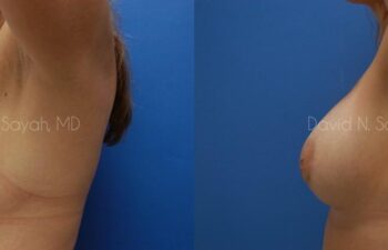 Breast Implant Exchange Before and After | Sayah Institute