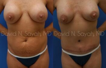 Tummy Tuck Before and After | Sayah Institute