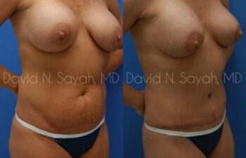 Tummy Tuck Before and After | Sayah Institute