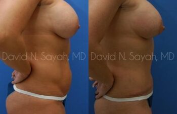 Tummy Tuck Before and After | Sayah Institute