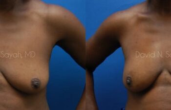 Breast Implant Revision Before and After | Sayah Institute