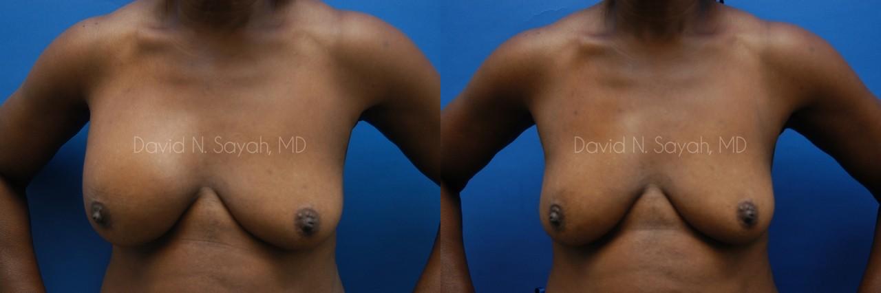 Breast Implant Revision Before and After | Sayah Institute