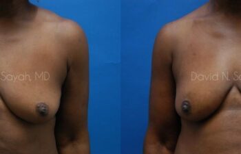 Breast Implant Revision Before and After | Sayah Institute